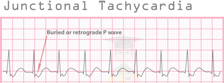 Tachycardia - Causes, Signs, Symptoms, Types, Diagnosis & Treatment