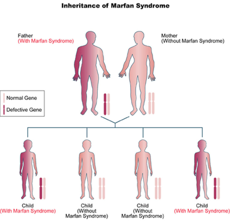 Marfan Syndrome - Causes, Symptoms, Prognosis, Diagnosis, Treatment