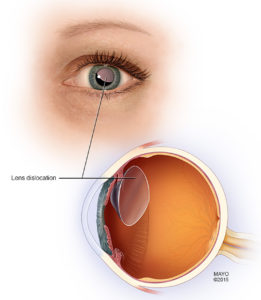 Marfan Syndrome - Causes, Symptoms, Prognosis, Diagnosis, Treatment