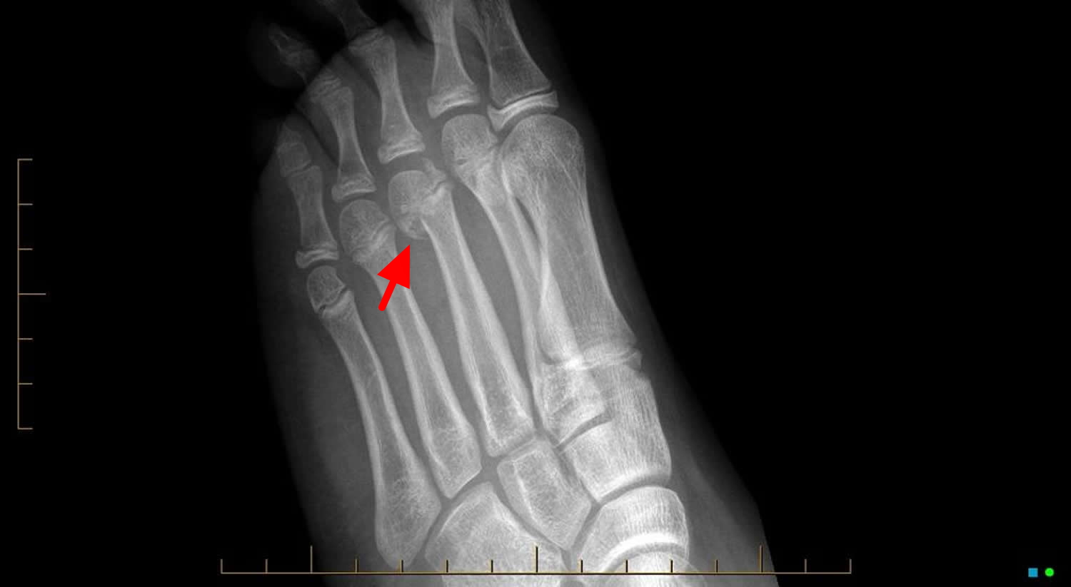 Growth Plate Fracture Causes, Types, Symptoms,Treatment