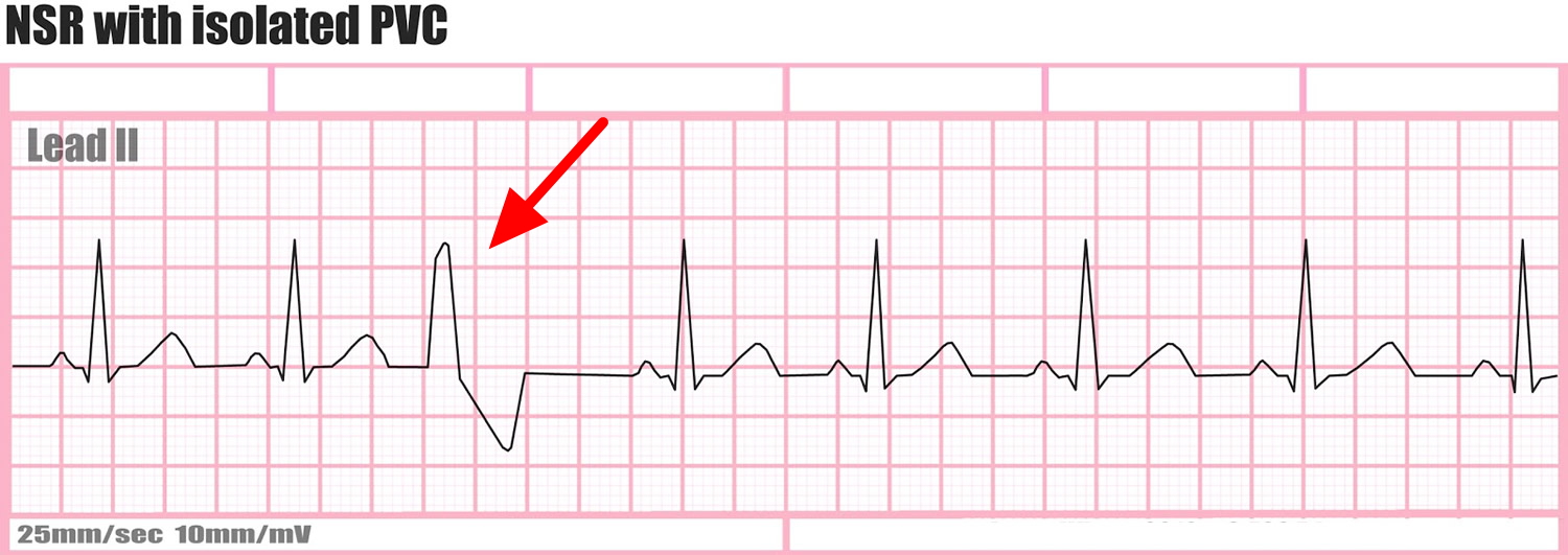 extra heartbeat lower at age 40