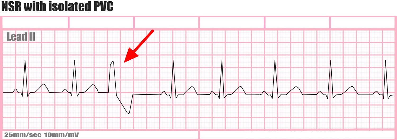 extra heartbeat in pots