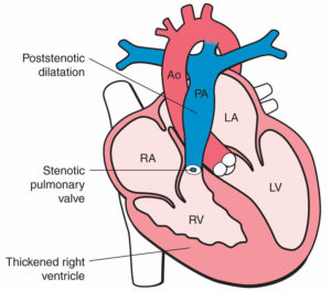 Pulmonary Atresia - Causes, Types, Symptoms, Diagnosis & Treatment