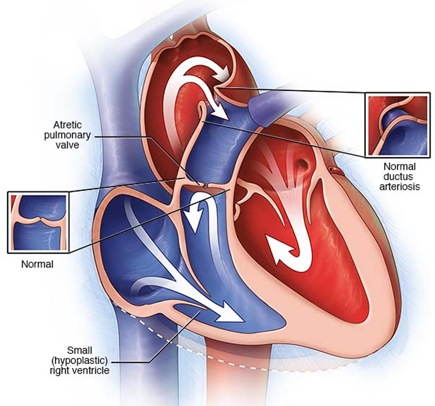 pulmonary-atresia-causes-types-symptoms-diagnosis-treatment