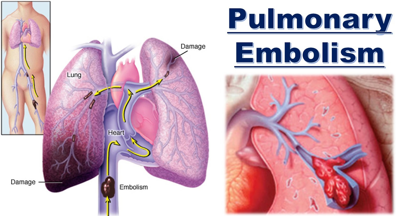 Pulmonary Embolism Causes, Signs & Symptoms, Diagnosis, Treatment