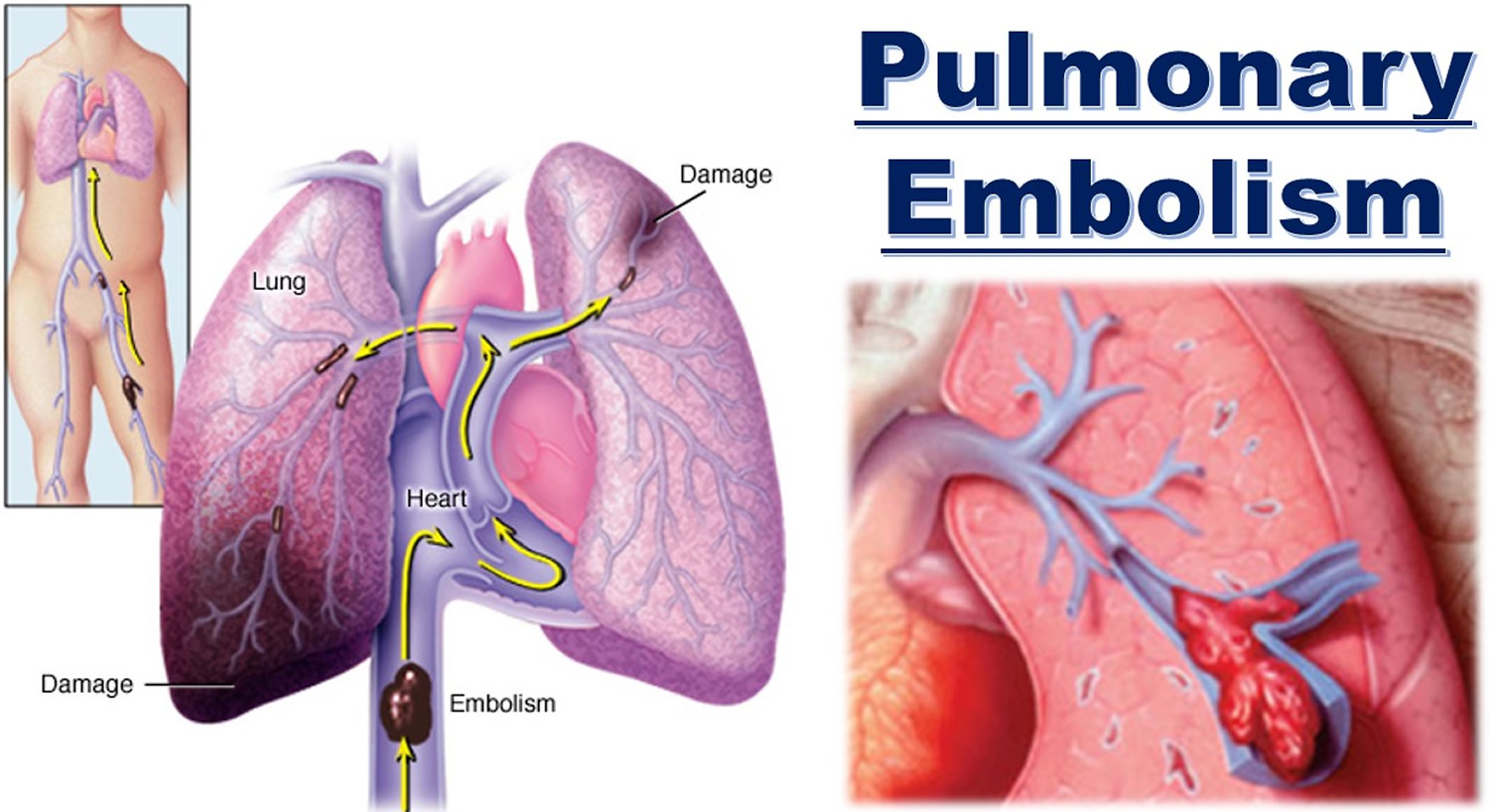 Pulmonary Embolism 