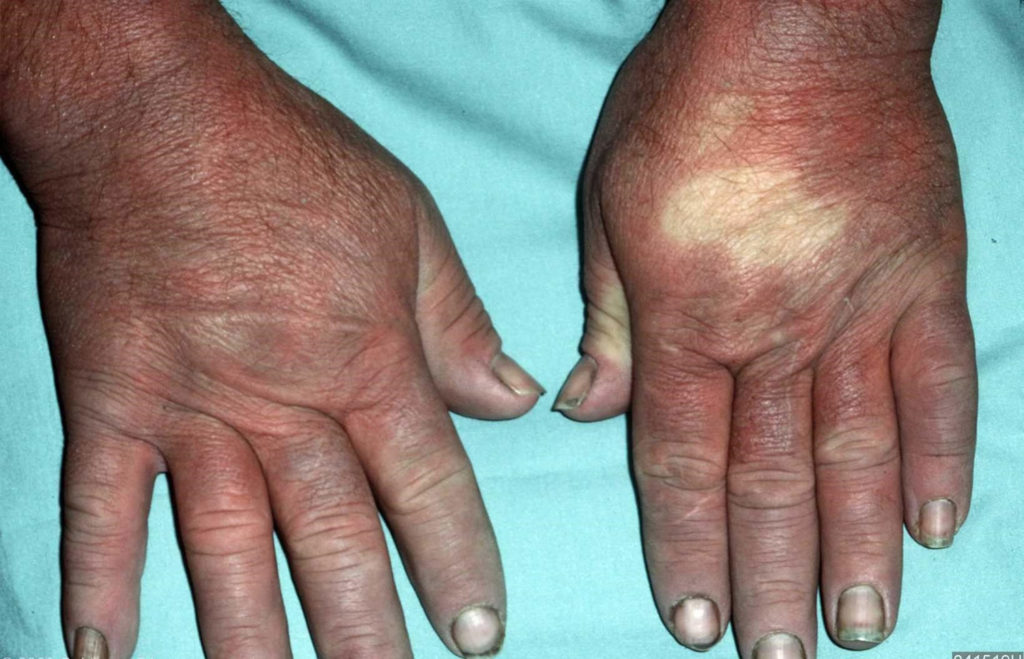 Scleroderma Causes Symptoms Prognosis Diagnosis Treatment