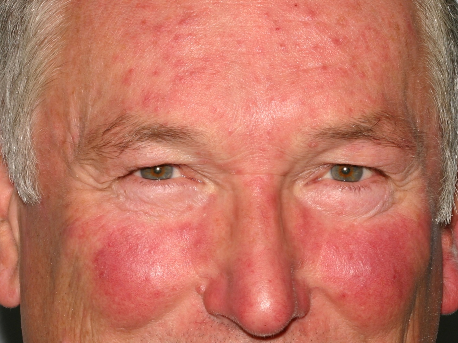 Rosacea Causes Symptoms Cream Diet And Rosacea Treatment