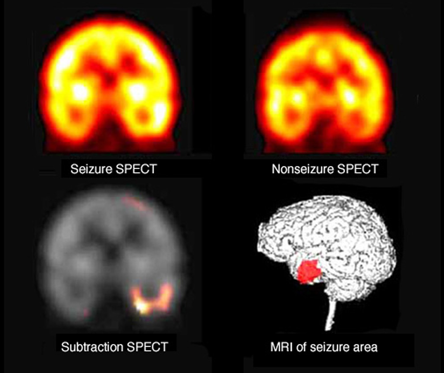 Grand Mal Seizure Causes Symptoms After Effects Recovery Time