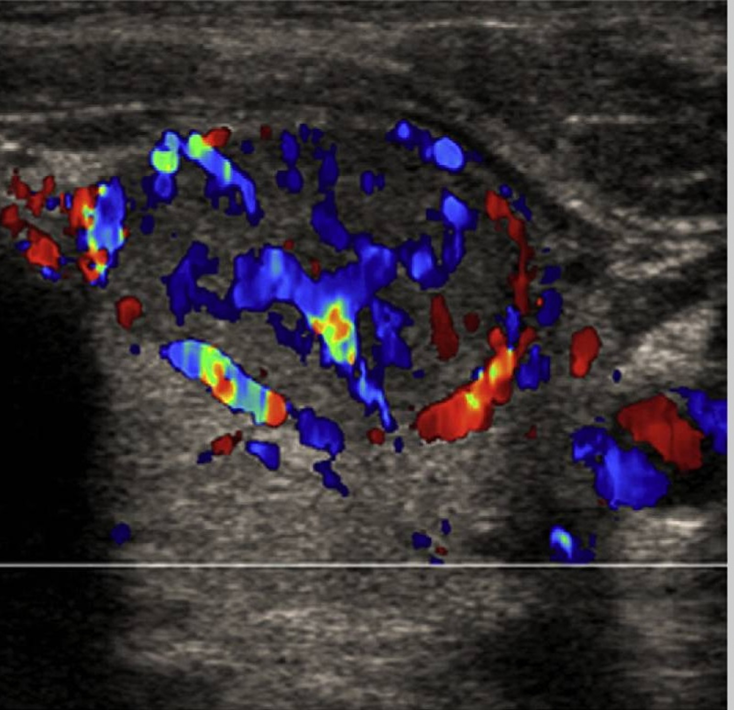 Collection 30+ Wallpapers pictures of thyroid nodules on an ultrasound Excellent