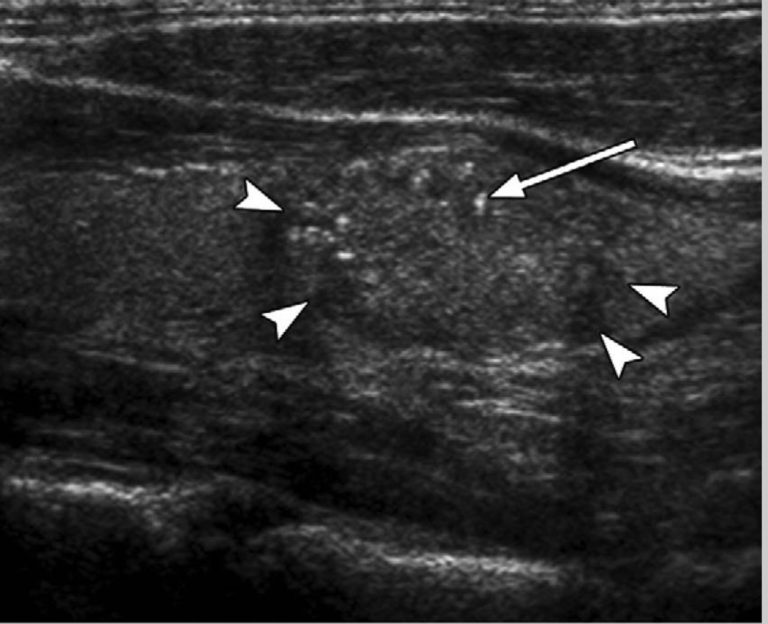 Thyroid Nodules - Causes, Symptoms, Ultrasound, Surgery