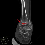 Growth Plate Fracture - Causes, Types, Symptoms,Treatment