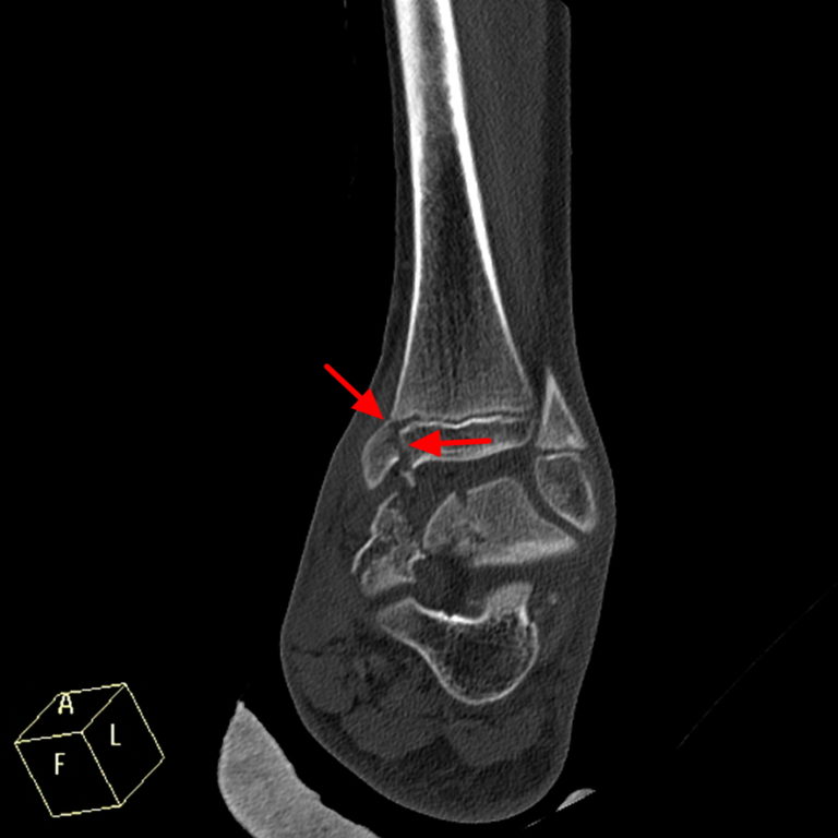 Growth Plate Fracture Causes, Types, Symptoms,Treatment