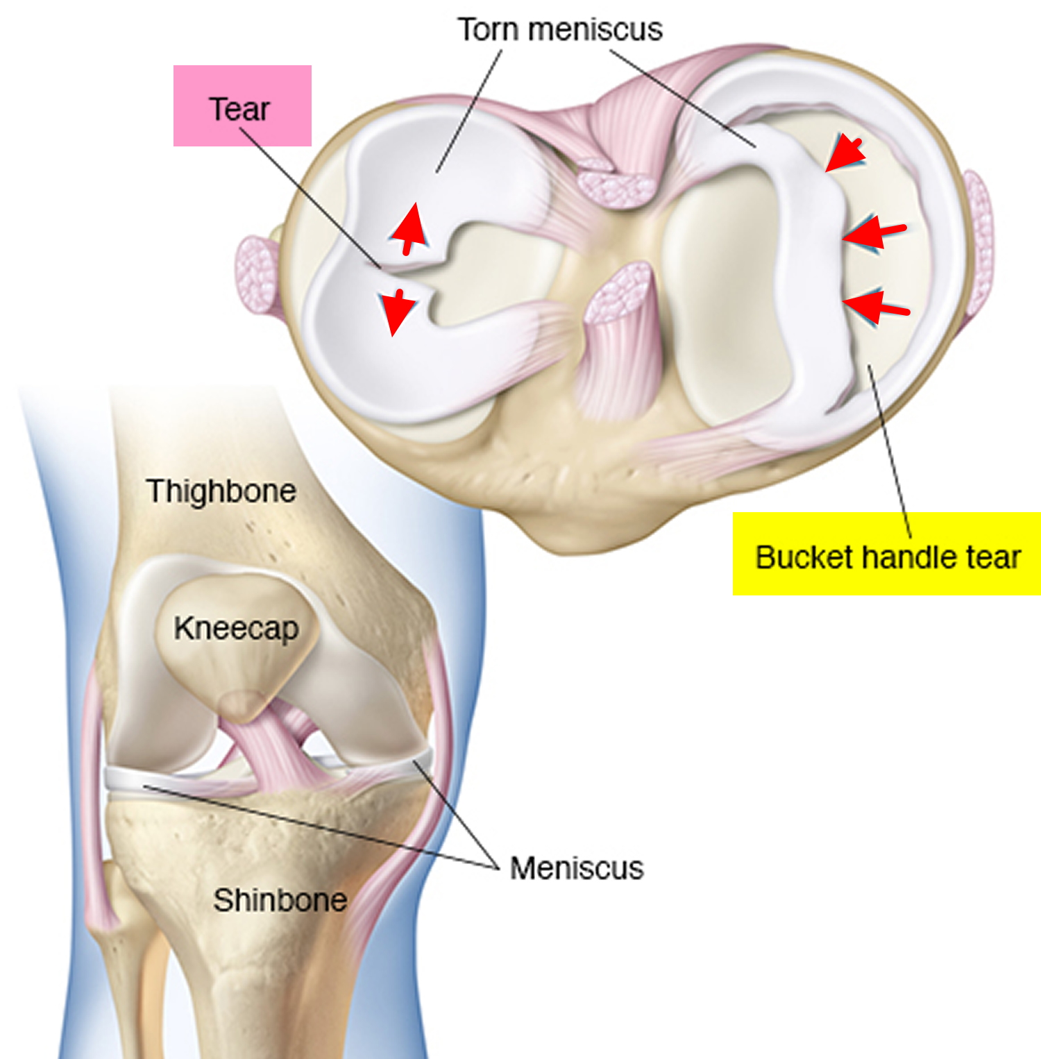 Torn Meniscus - Signs Symptoms Test Diagnosis Recovery Treatment