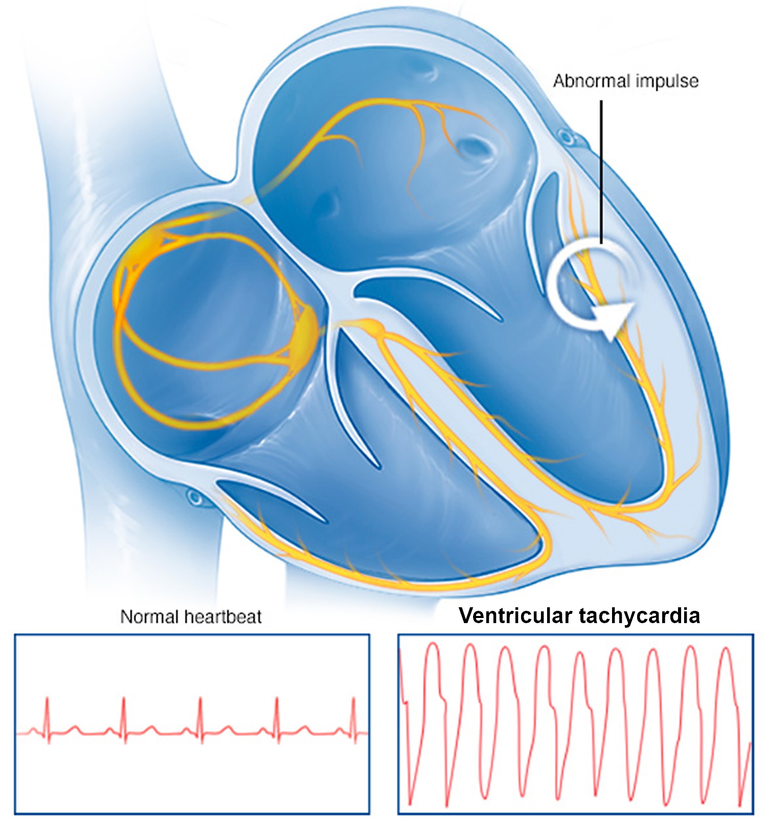 Tachycardia Causes, Signs, Symptoms, Types, Diagnosis & Treatment