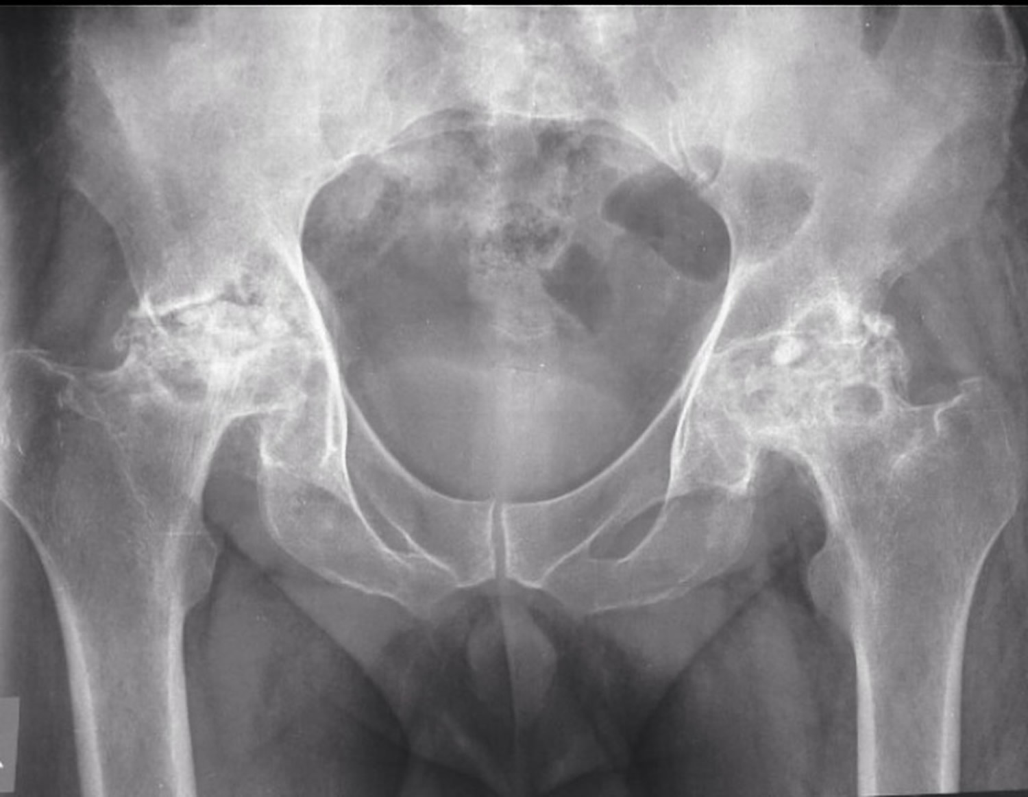 Некроз шейки бедра. Рентген асептический некроз бедренной кости. Коксартроз и асептический некроз. Асептический некроз тазобедренного рентген.