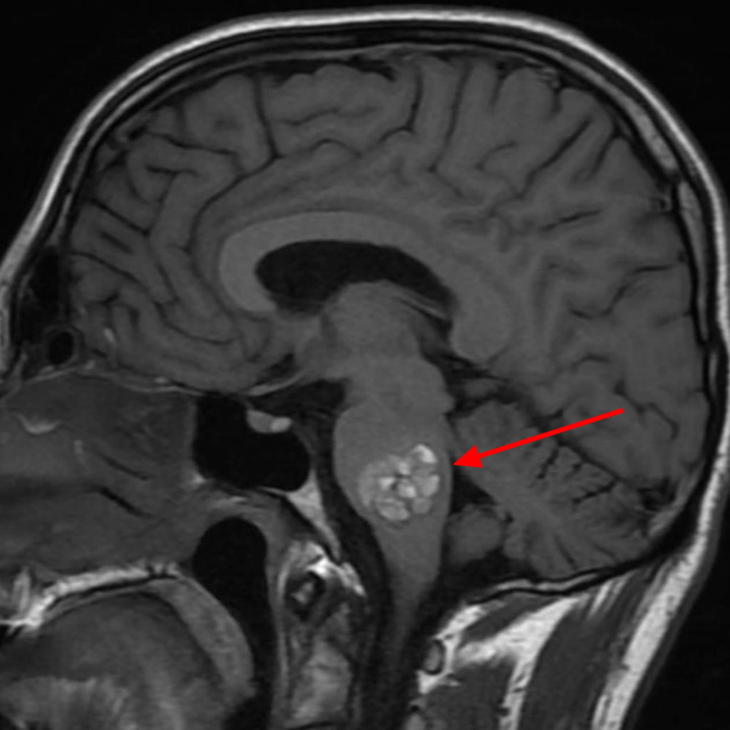 Cavernous Malformation - Cause, Brain Stem Symptoms, Treatment