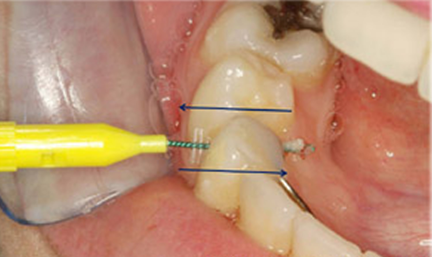 Periapical abscess causes, symptoms, diagnosis, treatment & prognosis