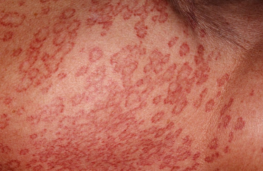 Granuloma Annulare - Causes, Rash, Treatment