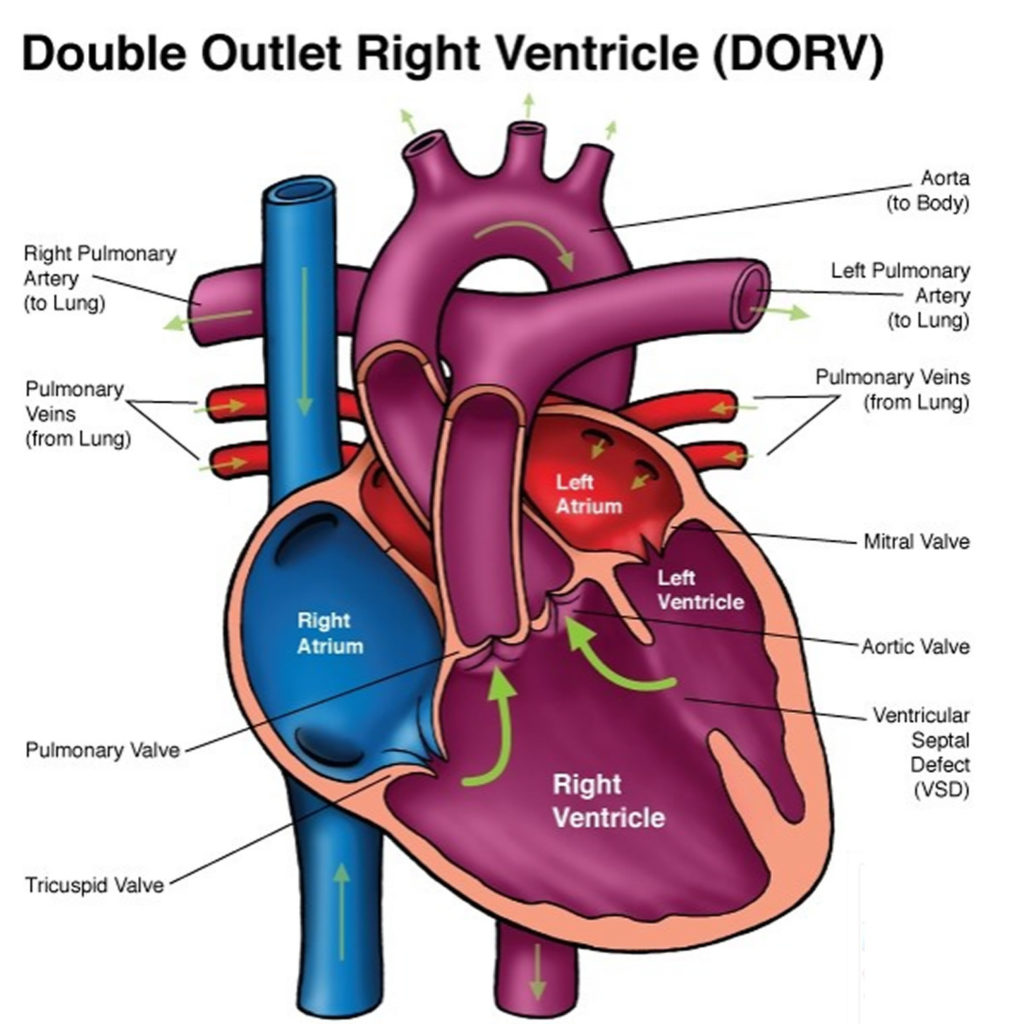 Double Outlet Right Ventricle Repair Surgery Survival Rate