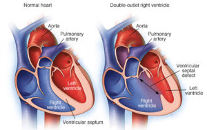 Double Outlet Right Ventricle - Repair, Surgery & Survival Rate