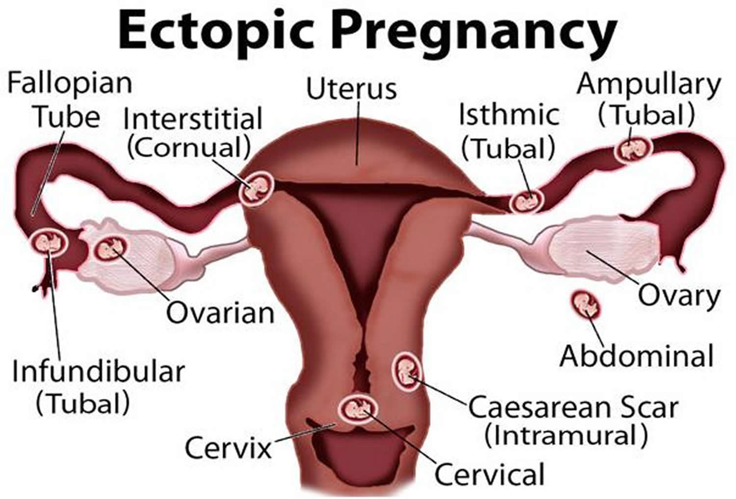 ectopic-pregnancy-causes-signs-symptoms-diagnosis-treatment