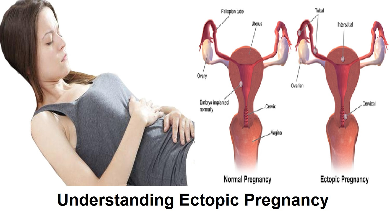 Ectopic Pregnancy - Causes, Signs, Symptoms, Diagnosis, Treatment