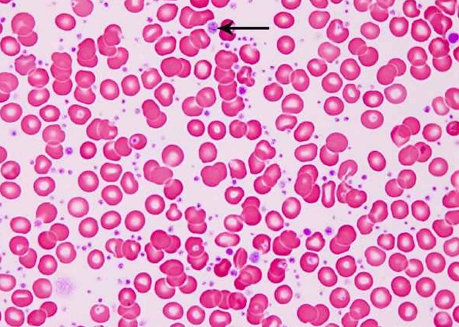 Essential Thrombocythemia Causes Symptoms Treatment