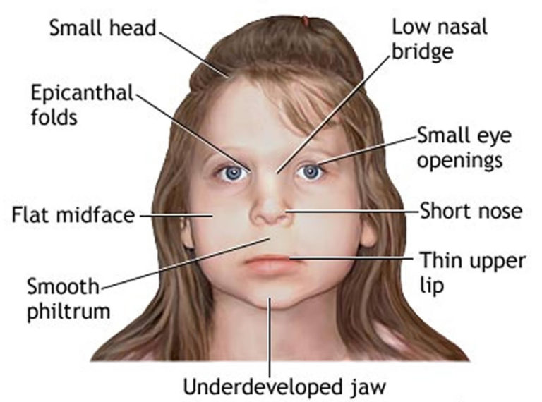 Adults With Fetal Alcohol Syndrome