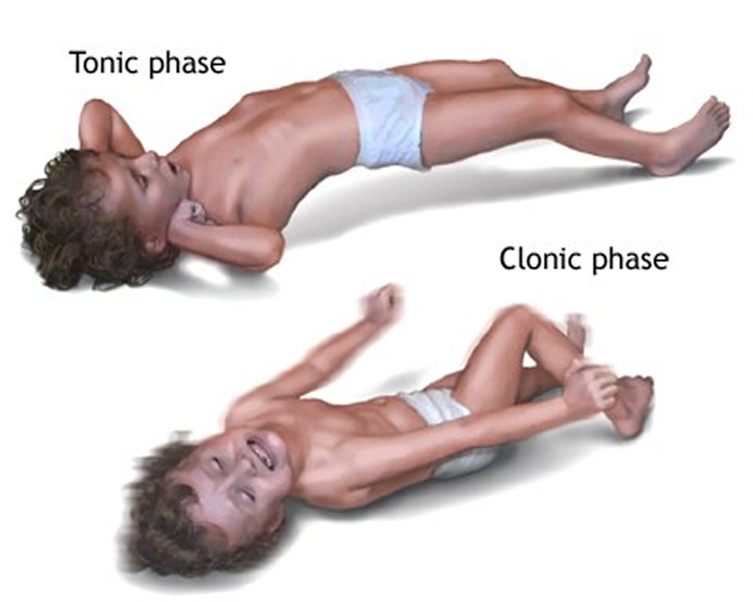 Припадки у детей. Тонические судороги столбняк. Тонические судороги у детей и клонические судороги. Эпилепсия судорожный синдром у ребенка. Клонические судороги клиника.