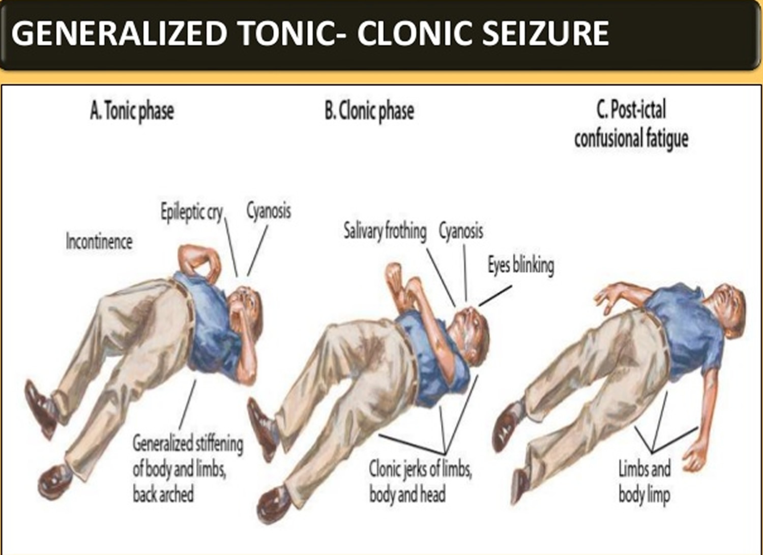 Can Seizures Cause White Spots On The Brain