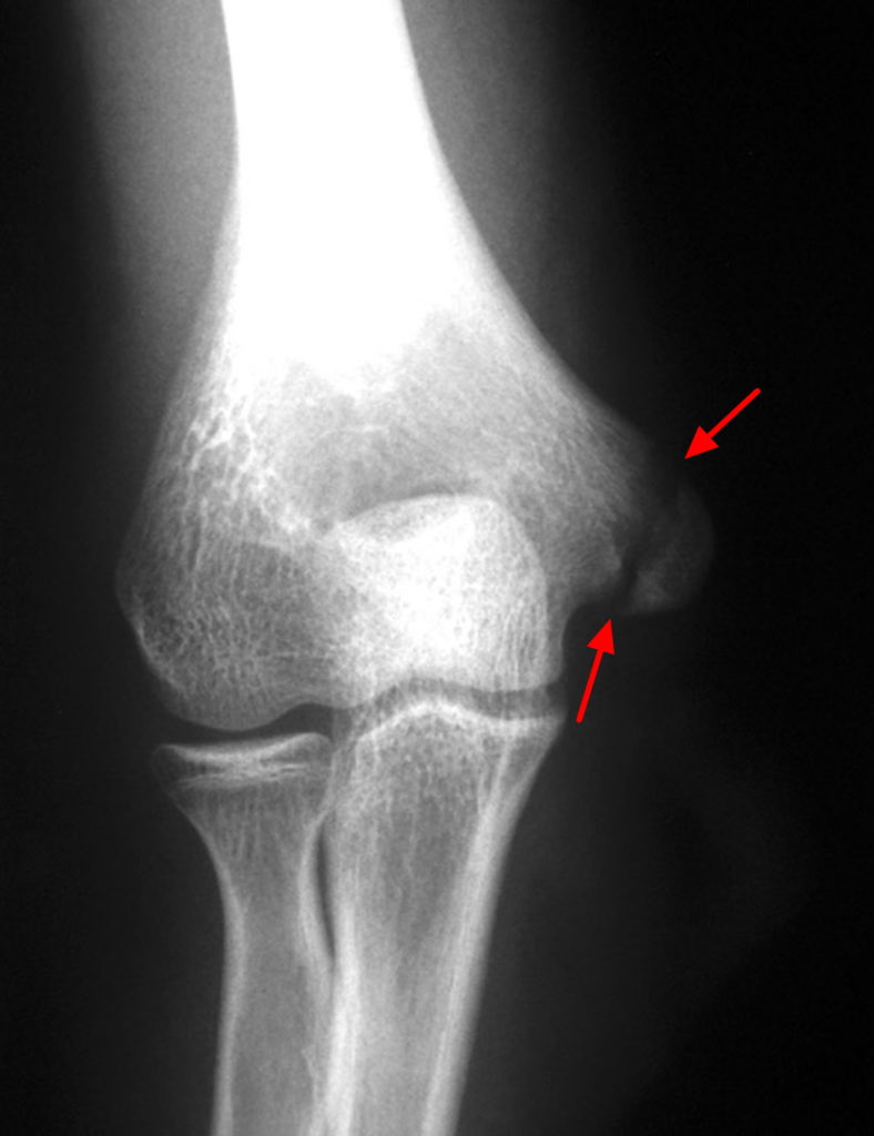 Growth Plate Fracture Causes Types Symptomstreatment 1114