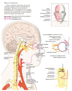 Horner's Syndrome - Causes, Signs & Symptoms, Diagnosis, Treatment