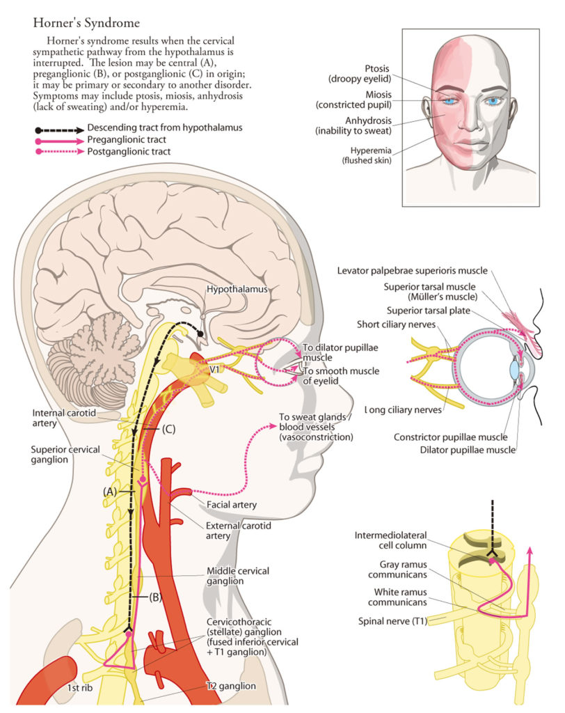 Horners Syndrome Causes Signs And Symptoms Diagnosis Treatment 9340