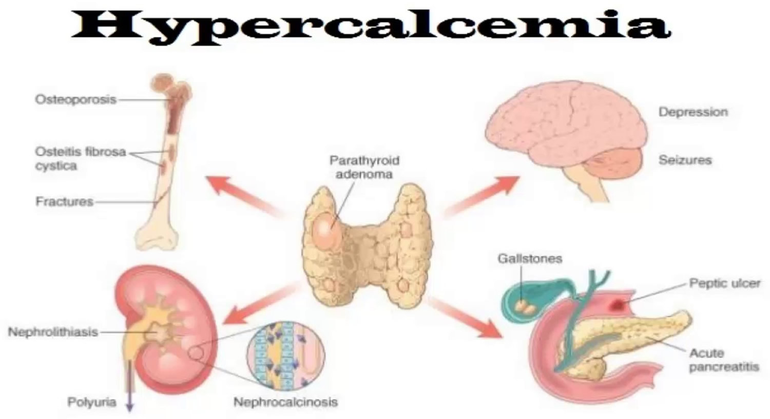 Hypercalcemia Causes Signs Symptoms Workup Treatment