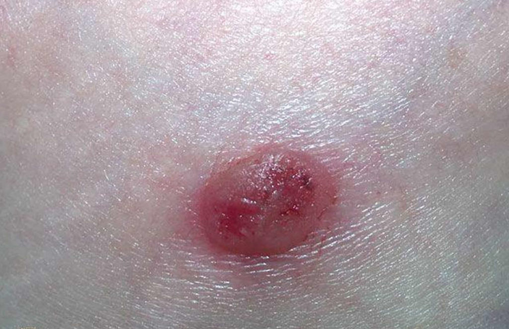 Keratosis Skin Cancer On Face