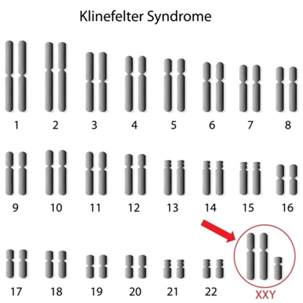 Klinefelter Syndrome Man