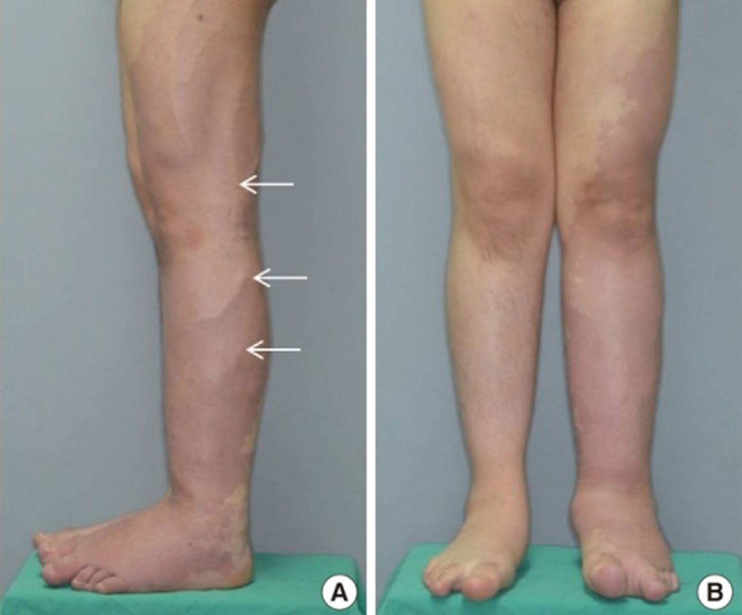 Klippel Trenaunay Syndrome Causes Diagnosis Prognosis Treatment