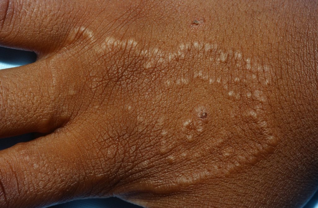 Granuloma Annulare Causes Rash Treatment