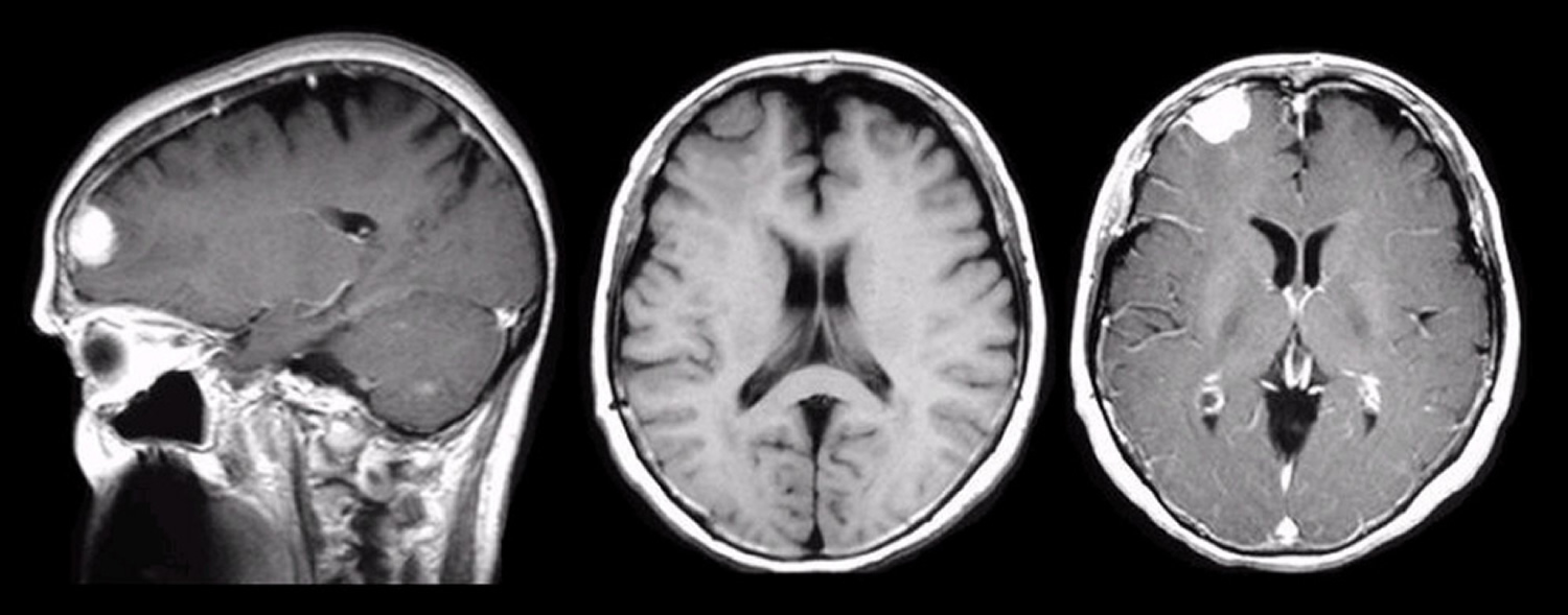 Meningioma Brain Tumor Causes Symptoms Survival Rate Treatment 