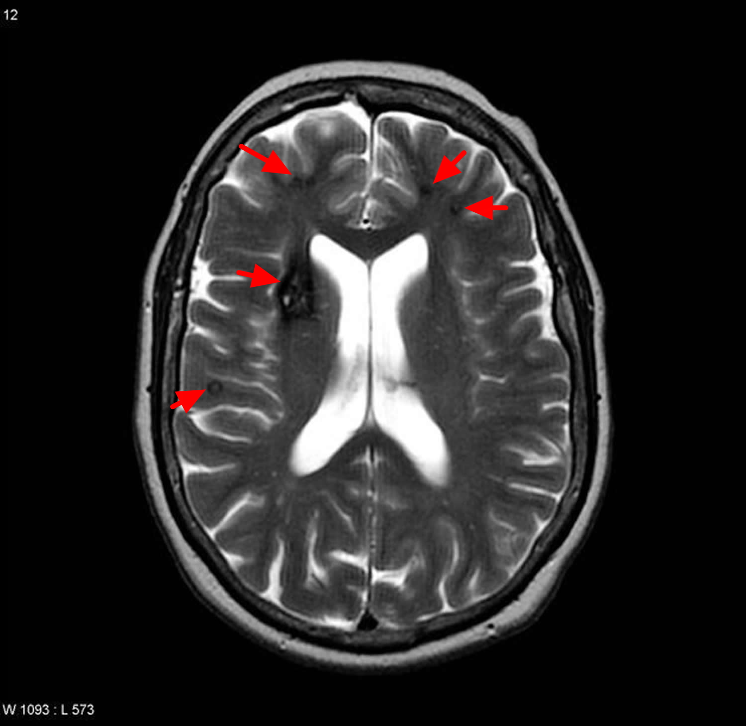 Cavernous Malformation Cause Brain Stem Symptoms Treatment Cavernous Malformation Cause Brain Stem Symptoms Treatment