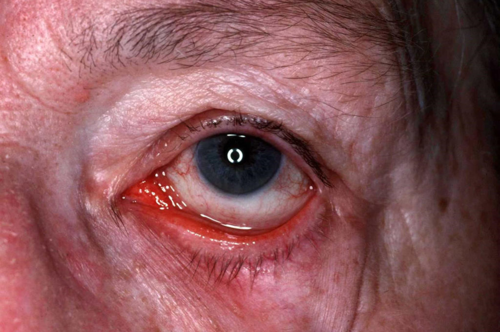 Ocular Rosacea Causes Triggers Symptoms Eye Drops Treatment 
