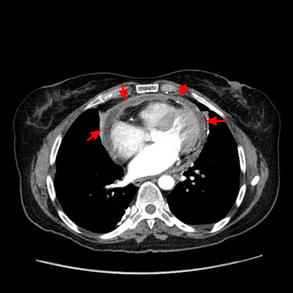 Pericardial Effusion Size