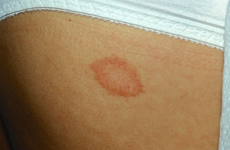 Pityriasis Rosea Causes Rash Herald Patch Stages Treatment 