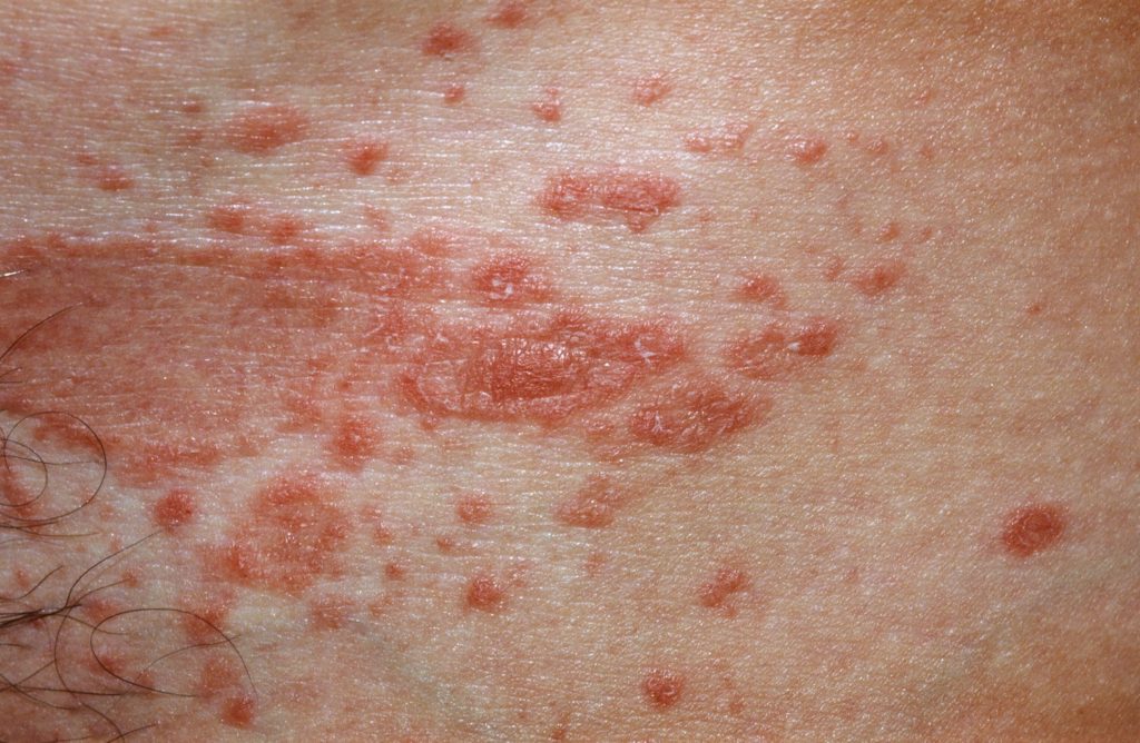 pityriasis-rosea-causes-rash-herald-patch-stages-treatment