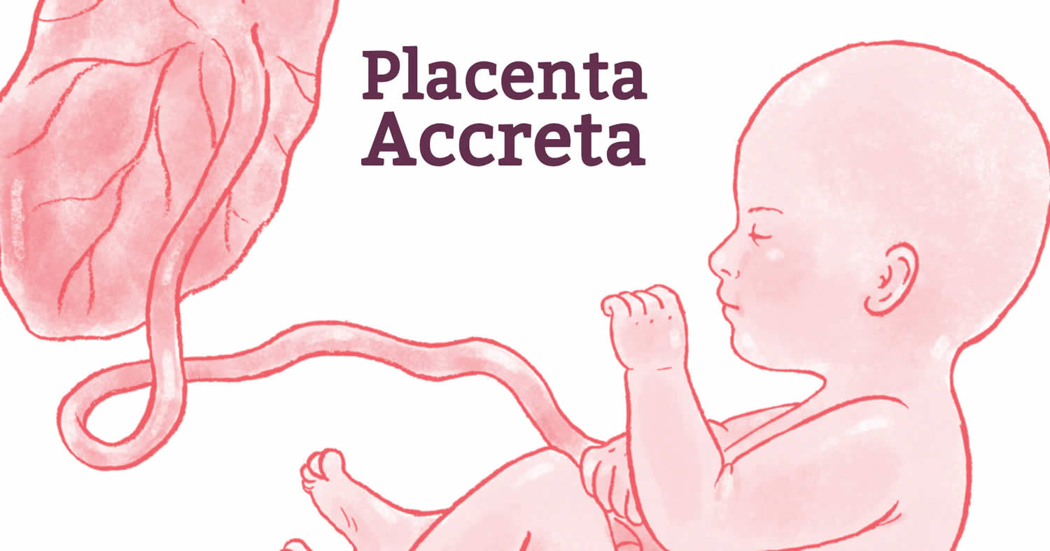 How Is Placenta Percreta Diagnosis