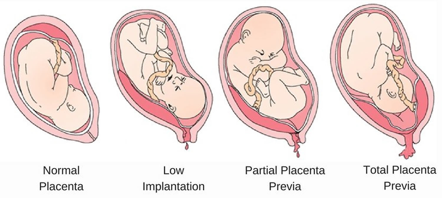 What Causes Placenta Previa Type 2