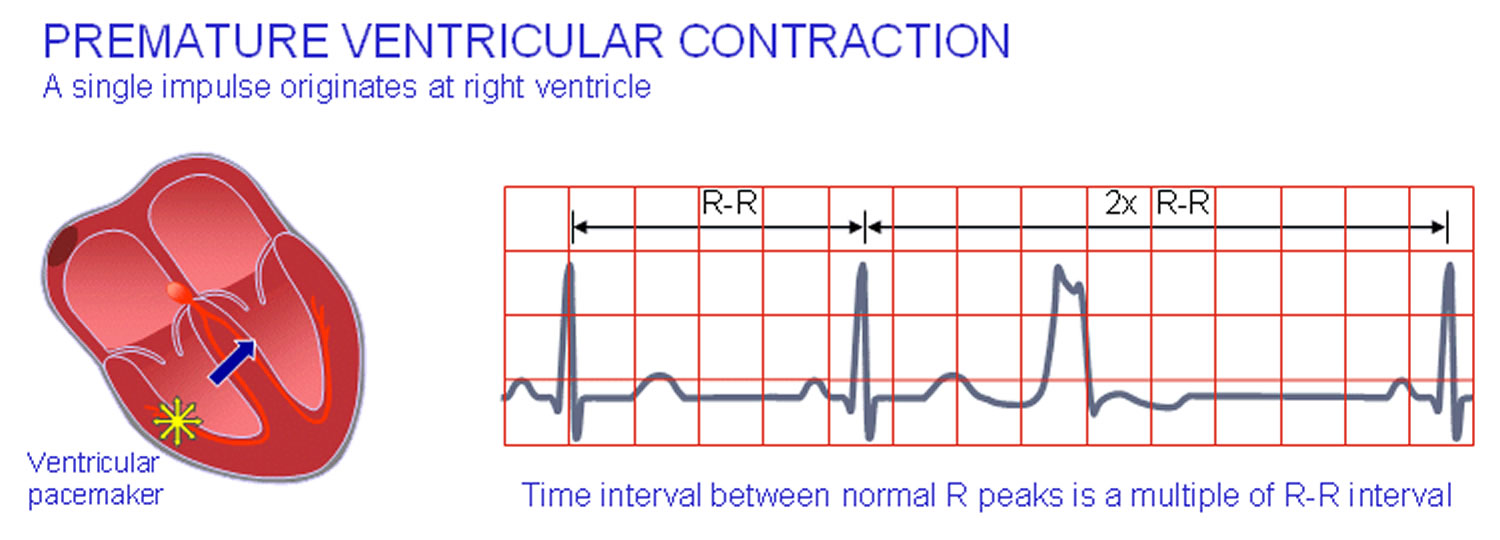 ventricular contraction timing