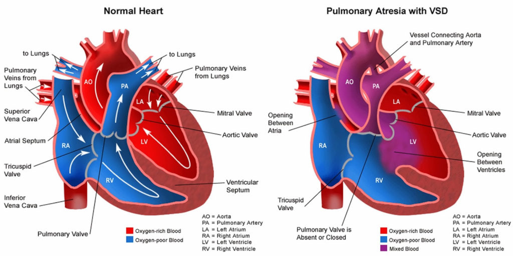 Pulmonary Atresia - Causes, Types, Symptoms, Diagnosis & Treatment