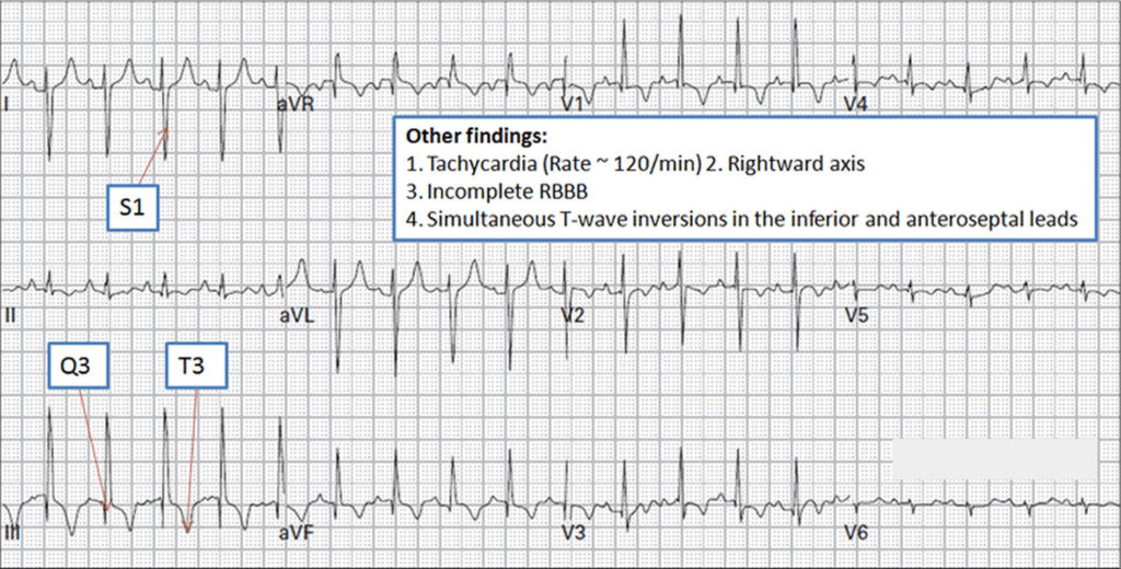 Pulmonary Embolism - Causes, Signs & Symptoms, Diagnosis, Treatment